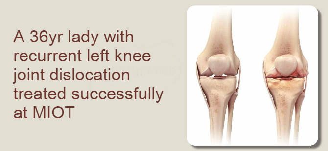 recurrent patellar dislocation