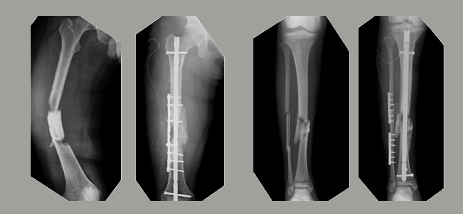 Grade III B Fracture Treated Successfully With Limb Reconstruction By ...